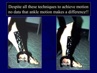 Despite all these techniques to achieve motion
no data that ankle motion makes a difference!!
 