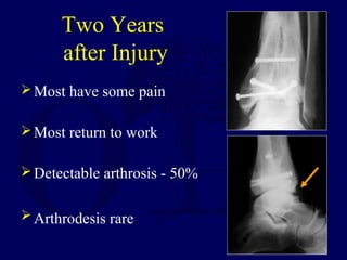 Two Years
after Injury
Most have some pain
Most return to work
Detectable arthrosis - 50%
Arthrodesis rare
 