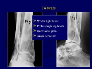 14 years
 Works light labor
 Prefers high top boots
 Occasional pain
 Ankle score 80
 