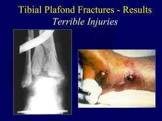 Tibial Plafond Fractures - Results
Terrible Injuries
 