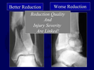 Better Reduction Worse Reduction
Reduction Quality
And
Injury Severity
Are Linked!
 