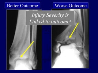 Better Outcome Worse Outcome
Injury Severity is
Linked to outcome!
 