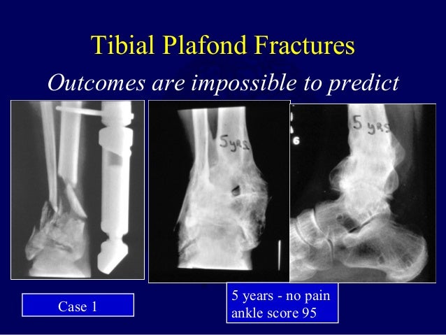 l11 pilon tibial plafond