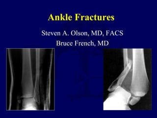 Ankle Fractures
Steven A. Olson, MD, FACS
Bruce French, MD
 