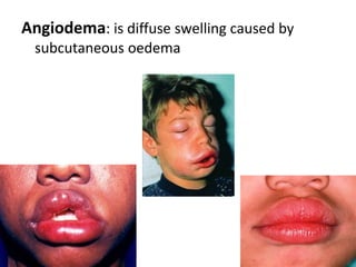 NailsHard keratin of nail plate  formed in nail matrix which lies in an invagination of epidermis on back of terminal phalanx of digits toesIt provide strength & protection for terminal phalanx & allow handling of fine objectsFinger nail growth is 0.5-1.2 mm per weekSlower in toe nailsFaster growth in summer
