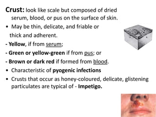 Papule: small solid elevation of skin < 5 mm in diameter.  Projects above the plane of the surrounding skin Flat-topped (in lichen planus) or Dome shaped (in xanthomas) or Spicular (if related to hair follicles)   