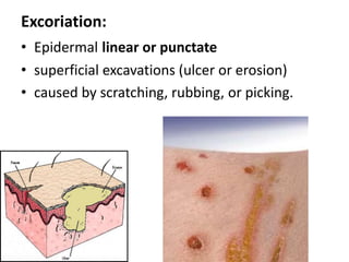 Nodule:palpable, solid, round, or ellipsoidal lesion  Its depth of involvement and/or palpability differentiate it from a papule rather than its diameter Larger than papules: > 5 mm diameter (in both depth & width)  Any layer of the skin Edematous or solid.  5 types of nodules: epidermal, epidermal-dermal, dermal,  dermal-subdermal, and subcutaneous