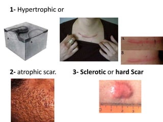 Cyst: an epithelial lined cavity containing liquid or semisolid material (fluid, cells, and cell products)  A spherical or oval papule or nodule may be a cyst if, when palpated, is resilient (feels like an eyeball). Plaque: palpable, plateau-like elevation of skin, usually more than 0.5 cm in diameter without substantial growth Often formed by a convergence of papules, as in psoriasis. 1. Plaques occupy a relatively large surface area in comparison with its height above the skin