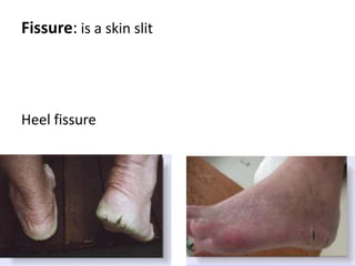 Wheal: elevated, transitory, compressible papule or plaque produced by dermal edemaThe papule or plaque is usually rounded or flat-toped, and evanescent, disappearing within hours.  The borders of a wheal are sharp, but not stable and can move from involved to adjacent uninvolved areas over hours.  The epidermisis not affected.  can be pale red or white (especially in the center) if edema is sufficient to compress superficial vessels.  