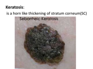 Abscess: localized collection of puss more than 1 cm in diameter 