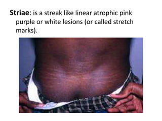 Angiodema: is diffuse swelling caused by subcutaneous oedema