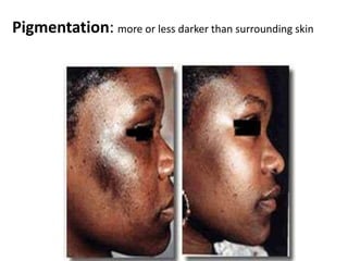 Tumor: is an enlargement of the tissue by normal or pathological material or cell greater than 1 cm in diameter