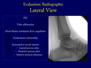 Evaluation: Radiographic 
Lateral View 
PM 
Talar subluxation 
Distal fibular translation &/or angulation 
Syndesmotic relationship 
Associated or occult injuries 
– Lateral process talus 
– Posterior process talus 
– Anterior process calcaneus 
 