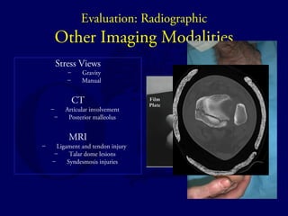 Evaluation: Radiographic 
Other Imaging Modalities 
Stress Views 
– Gravity 
– Manual 
CT 
– Articular involvement 
– Posterior malleolus 
MRI 
– Ligament and tendon injury 
– Talar dome lesions 
– Syndesmosis injuries 
 
