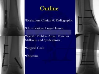 Outline 
•Evaluation: Clinical & Radiographic 
•Classification: Lauge-Hansen 
•Specific Problem Areas: Posterior 
Malleolus and Syndesmosis 
•Surgical Goals 
•Outcome 
 