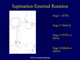 Supination-External Rotation 
Stage 1- AITFL 
Stage 2- Fibula fx 
Stage 3- PITFL or 
PM fx 
Stage 4-Deltoid or 
MM fx 
70% of ankle fractures 
 