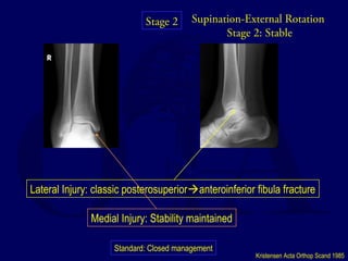 Supination-External Rotation 
Stage 2: Stable 
Lateral Injury: classic posterosuperioranteroinferior fibula fracture 
Medial Injury: Stability maintained 
Standard: Closed management 
Kristensen Acta Orthop Scand 1985 
Stage 2 
 
