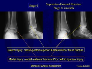 Supination-External Rotation 
Stage 4: Unstable 
Stage 4 
Lateral Injury: classic posterosuperioranteroinferior fibula fracture 
Medial Injury: medial malleolar fracture &*/or deltoid ligament injury 
Standard: Surgical management *Tornetta JBJS 2000 
 
