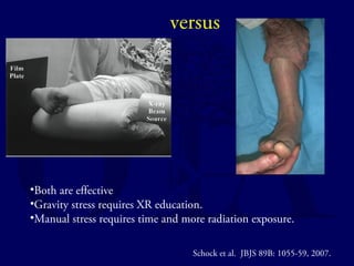 versus 
•Both are effective 
•Gravity stress requires XR education. 
•Manual stress requires time and more radiation exposure. 
Schock et al. JBJS 89B: 1055-59, 2007. 
 