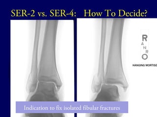 SER-2 vs. SER-4: How To Decide? 
Indication to fix isolated fibular fractures 
 