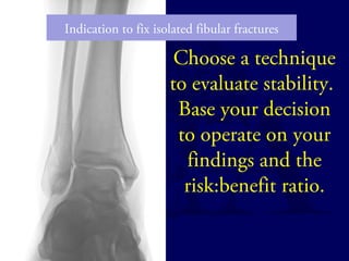 Indication to fix isolated fibular fractures 
Choose a technique 
to evaluate stability. 
Base your decision 
to operate on your 
findings and the 
risk:benefit ratio. 
 