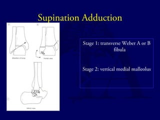 Supination Adduction 
Stage 1: transverse Weber A or B 
fibula 
Stage 2: vertical medial malleolus 
 