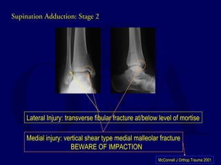 Supination Adduction: Stage 2 
Lateral Injury: transverse fibular fracture at/below level of mortise 
Medial injury: vertical shear type medial malleolar fracture 
BEWARE OF IMPACTION 
McConnell J Orthop Trauma 2001 
 