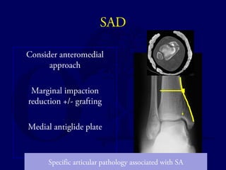 SAD 
Consider anteromedial 
approach 
Marginal impaction 
reduction +/- grafting 
Medial antiglide plate 
Specific articular pathology associated with SA 
 