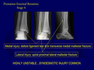 Pronation External Rotation: 
Stage 4 
Medial injury: deltoid ligament tear &/or transverse medial malleolar fracture 
Lateral Injury: spiral proximal lateral malleolar fracture 
HIGHLY UNSTABLE…SYNDESMOTIC INJURY COMMON 
 