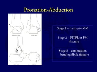 Pronation-Abduction 
Stage 1 – transverse MM 
Stage 2 – PITFL or PM 
fracture 
Stage 3 – compression 
bending fibula fracture 
 