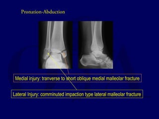 Pronation-Abduction 
Medial injury: tranverse to short oblique medial malleolar fracture 
Lateral Injury: comminuted impaction type lateral malleolar fracture 
 