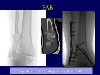 PAB 
Specific articular pathology associated with PAB 
 
