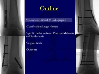 Outline 
•Evaluation: Clinical & Radiographic 
•Classification: Lauge-Hansen 
•Specific Problem Areas: Posterior Malleolus 
and Syndesmosis 
•Surgical Goals 
•Outcome 
 