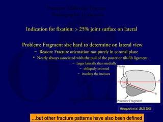 Posterior Malleolus Fracture: 
Radiographic Evaluation 
Indication for fixation: > 25% joint surface on lateral 
Problem: Fragment size hard to determine on lateral view 
– Reason: Fracture orientation not purely in coronal plane 
• Nearly always associated with the pull of the posterior tib-fib ligament 
– larger laterally than medially 
– obliquely oriented 
– involves the incisura 
Haraguchi et al. JBJS 2006 
…but other fracture patterns have also been defined 
 