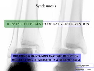 Syndesmosis 
IF INSTABILITY PRESENT OPERATIVE INTERVENTION 
OBTAINING & MAINTAINING ANATOMIC REDUCTION 
REDUCES LONG TERM DISABILITY & IMPROVES sMFA 
Leeds JBJS 1984 
Weening JOT 2005 
 