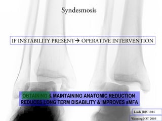Syndesmosis 
IF INSTABILITY PRESENT OPERATIVE INTERVENTION 
OBTAINING & MAINTAINING ANATOMIC REDUCTION 
REDUCES LONG TERM DISABILITY & IMPROVES sMFA 
Leeds JBJS 1984 
Weening JOT 2005 
 