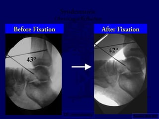 Before Fixation After Fixation 
43° 
42° 
Syndesmosis: 
Obtaining a Reduction 
DF unnecessary Tornetta JBJS 2001 
 