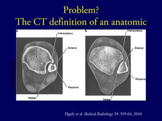Problem? 
The CT definition of an anatomic 
syndesmosis 
Elgafy et al. Skeletal Radiology 39: 559-64, 2010 
 