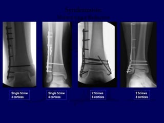Syndesmosis: 
Maintaining a Reduction 
Single Screw 
3 cortices 
Single Screw 
4 cortices 
2 Screws 
6 cortices 
2 Screws 
8 cortices 
 