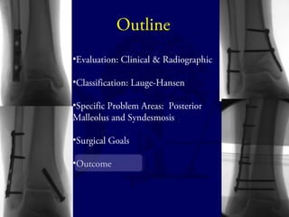 Outline 
•Evaluation: Clinical & Radiographic 
•Classification: Lauge-Hansen 
•Specific Problem Areas: Posterior 
Malleolus and Syndesmosis 
•Surgical Goals 
•Outcome 
 