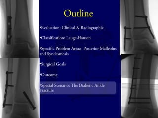 Outline 
•Evaluation: Clinical & Radiographic 
•Classification: Lauge-Hansen 
•Specific Problem Areas: Posterior Malleolus 
and Syndesmosis 
•Surgical Goals 
•Outcome 
•Special Scenario: The Diabetic Ankle 
Fracture 
 