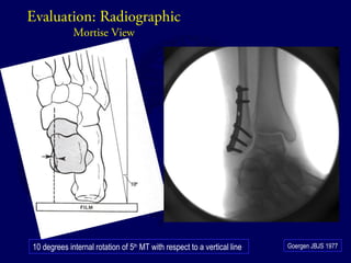 Evaluation: Radiographic 
Mortise View 
10 degrees internal rotation of 5th MT with respect to a vertical line Goergen JBJS 1977 
 