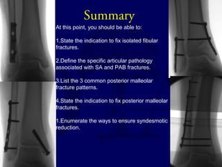Summary 
At this point, you should be able to: 
1.State the indication to fix isolated fibular 
fractures. 
2.Define the specific articular pathology 
associated with SA and PAB fractures. 
3.List the 3 common posterior malleolar 
fracture patterns. 
4.State the indication to fix posterior malleolar 
fractures. 
1.Enumerate the ways to ensure syndesmotic 
reduction. 
 