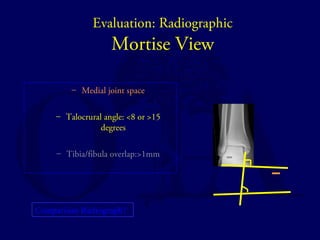 Evaluation: Radiographic 
Mortise View 
– Medial joint space 
– Talocrural angle: <8 or >15 
degrees 
– Tibia/fibula overlap:>1mm 
Comparison Radiograph? 
 