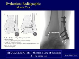 Evaluation: Radiographic 
Mortise View 
Weber SICOT 1981 
FIBULAR LENGTH: 1. Shenton’s Line of the ankle 
2. The dime test 
 