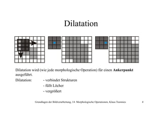 Dilatation

Dilatation wird (wie jede morphologische Operation) für einen Ankerpunkt
ausgeführt.
Dilatation:
- verbindet Strukturen
- füllt Löcher
- vergrößert
Grundlagen der Bildverarbeitung, 14. Morphologische Operationen, Klaus Toennies

4

 