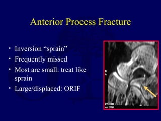 Anterior Process Fracture
• Inversion “sprain”
• Frequently missed
• Most are small: treat like
sprain
• Large/displaced: ORIF
 
