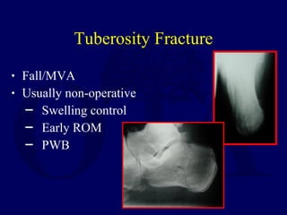 • Fall/MVA
• Usually non-operative
─ Swelling control
─ Early ROM
─ PWB
Tuberosity Fracture
 