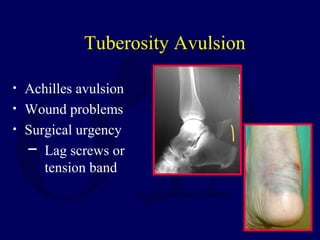 Tuberosity Avulsion
• Achilles avulsion
• Wound problems
• Surgical urgency
─ Lag screws or
tension band
 