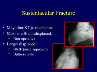 Sustentacular Fracture
• May alter ST jt. mechanics
• Most small/ nondisplaced:
─ Non-operative
• Large/ displaced
─ ORIF (med. approach)
─ Buttress plate
 